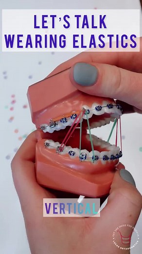 Wearing Vertical Elastics for Braces Explained