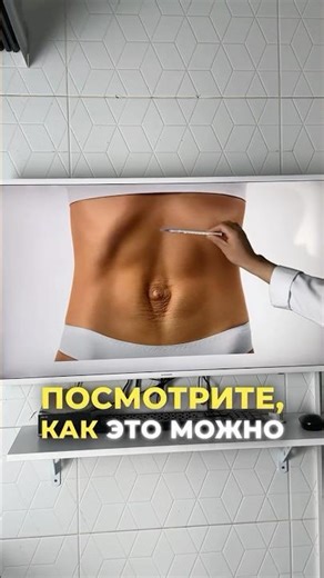 Диастаз, расхождение прямых мышц живота, которое возникает после беременности или резкого похудения