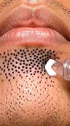 Satisfying Deep Blackhead Removal ASMR 😱 part 1 #pimplepop #blackheadremoval #satisfying #skincare #asmr