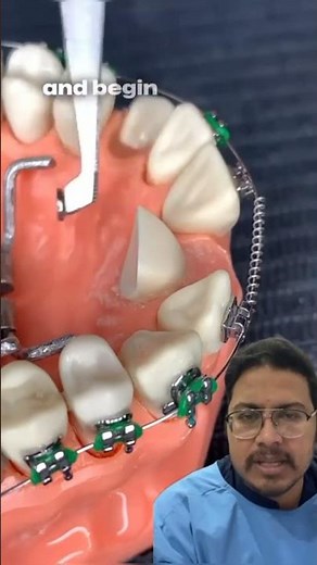 Precision Tooth Alignment: A Gentle\nOrthodontic Journey🦷