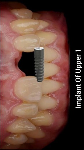 implant motion graphic
