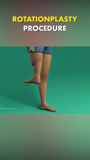 Rotationplasty Surgery: A Unique Procedure Explained