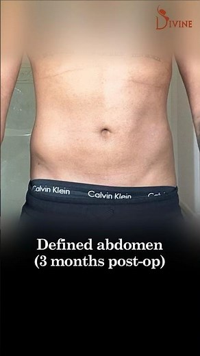 Male Abdomen Liposuction Before and After #shortsfeed
