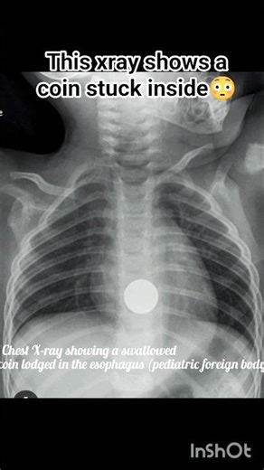 #xray #shortsfeed #shorts