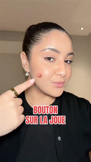 1 bouton = 1 zone du visage = 1 cause #acne #bouton #skincare