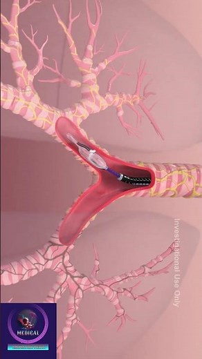 Lung Denervation Procedure - COPD Disease Treatment #lungdisease