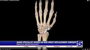 Medical Breakthroughs: Hand specialist working on new wrist replacement surgery