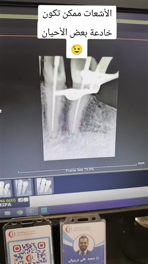 استخدام جهاز Apex Locator في علاج الجذور