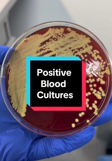 Understanding Blood Culture Testing in Microbiology Labs