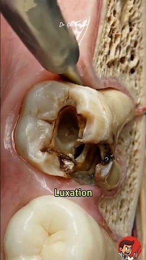 What happens when a tooth breaks during an extraction? Video by Dr ‪@Dr.Carienator‬