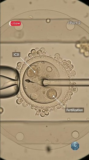 IVF Lab Fertilization (ICSI): How a Single Sperm Can Fertilize an Egg #ivf #ivfjourney #ai #viral