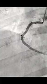 Angioplasty to LAD and LCX in NSTEMI.