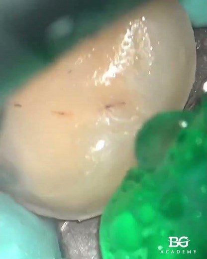 Overlay prep. #preparation #dentisteducation #dentalhacks