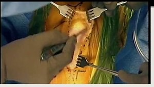 Mini-Midvastus Approach to TKA