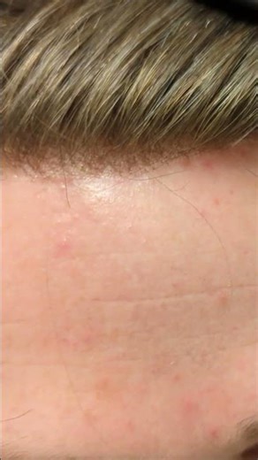 Before & After - Hair System - Hair Loss To Full Hair In Seconds! Hair Replacement For Men #shorts