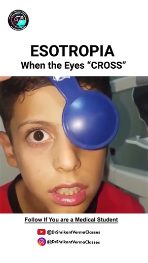 Unlocking the Mystery of Esotropia: What You Need to Know! | Esotropia Explained