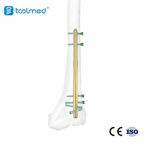 [Hot Item] Orthopedic Trauma Interlocking Intramedullary Nail for Femur 9.5*340