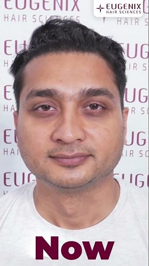 Hair Transplant Results | Must-See Before and After Transformation