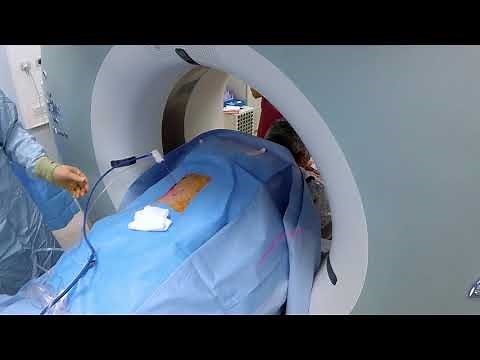 Renal tumour microwave ablation under CT guidance
