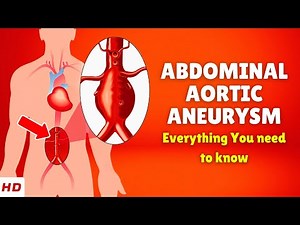 Abdominal aortic aneurysm – Causes, Signs and Symptoms, Diagnosis & Treatment