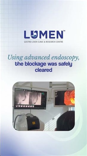 CBD Stone Removal with ERCP | Advanced Endoscopy Treatment Without Surgery | LUMEN Surat