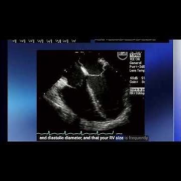 Distributive Shock on TEE – Differentiate from Hypovolemia and Direct Resuscitation