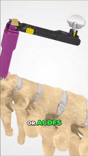 Spine Surgery Instruments and Techniques