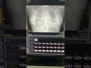 Complete method of CTPA on Toshiba Super CT scanner | #angiography #ct #CTPA