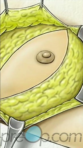 🔍 PreOp® Mastectomy – Modified Radical Patient Ed 💡Master Key Steps Quickly✨ #shorts