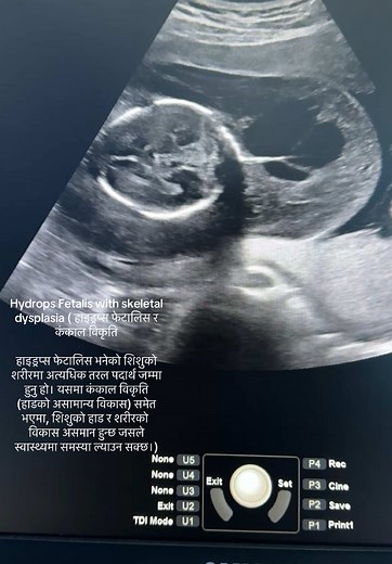 हाइड्रप्स फेटालिस र कंकाल विकृति (Hydrops Fetalis with skeletal dysplasia) Description: Hydrops fetalis is a serious condition where excessive fluid accumulates in the body of a fetus or newborn. When this condition is associated with skeletal dysplasia, the fetus experiences abnormal growth of the bones and skeleton. This can result in issues such as shortened limbs, weak bones, or a narrow chest. This condition can lead to complications either before birth or immediately after, potentially cau
