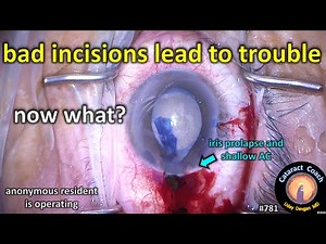 bad incisions lead to trouble during cataract surgery