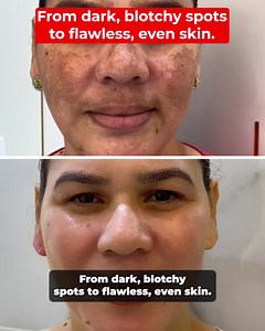 Still think age spots come from too much ☀️? Féline Skinscience exposes the TRUE cause and solution! ✅ Fades acne marks, age spots, melasma ✅ Clinically proven, dermatologist-recommended ✅ No Makeup ✅ No Prescriptions ✅ No Expensive Treatments Most women are using the wrong approach. That’s why spots keep coming back—even after endless creams and serums. Féline’s Dark Spot Corrector targets the real cause, working deep in the skin for visible, lasting results. Illuminate Your Skin Now! 🔽 https: