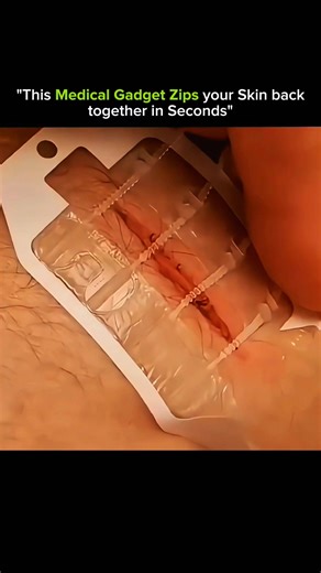 KNOWLEDGE HUB on Instagram: "🩹 This Medical Gadget Zips Your Skin Back Together in Seconds • This device is called a medical skin closure zipper. • It’s designed to close wounds without stitches or staples. • Adhesive strips are placed on both sides of the cut. • A tiny zipper mechanism pulls the skin edges together. • The closure happens evenly and gently. • This reduces stress on the wound. • Less tension means faster healing. • It also lowers the risk of scarring. • No needles are required.