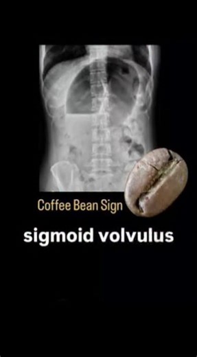 RK NURSE'S HUB on Instagram: "The "coffee bean sign" is a classic radiological finding on an abdominal X-ray that is considered pathognomonic for a sigmoid volvulus, a life-threatening condition requiring emergency intervention. This sign appears as a greatly dilated, inverted U-shaped loop of the sigmoid colon that resembles a coffee bean. Formation: The two curved outer borders of the "bean" are the walls of the gas-filled, massively distended bowel loops. The central white cleft (or line) rep