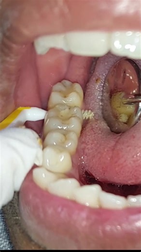 Nepalidentist on Instagram: "Proxa brush are small yet effective tool to maintain oral health #proxabrush #periodontitis #nepalidentist #drbiplob #gumdisease"