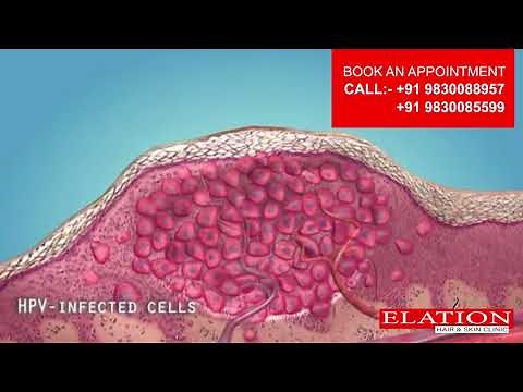 Wart & Mole Removal | Electric Cautery | Elation Clinic