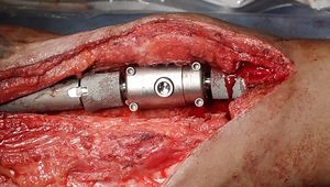 Revision Knee Arthrodesis with Distal Femur Endoprosthesis