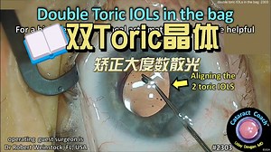 【中英】【特殊白内障手术：双Toric晶体矫正大度数散光】double toric IOLs in the capsular bag