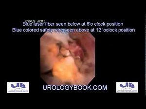 Ureteroscopy For Ureter Stone Laser Lithotripsy Extraction • Video • MEDtube.net