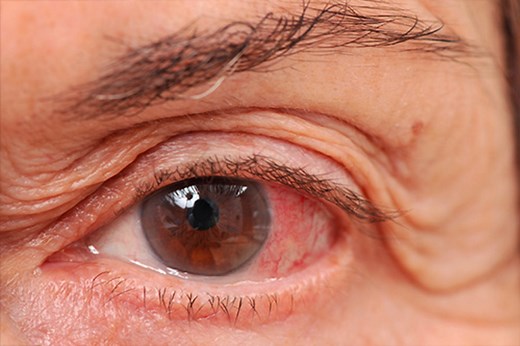 Open Angle Glaucoma (also known as Chronic Glaucoma) - Healthtips by TeleMe