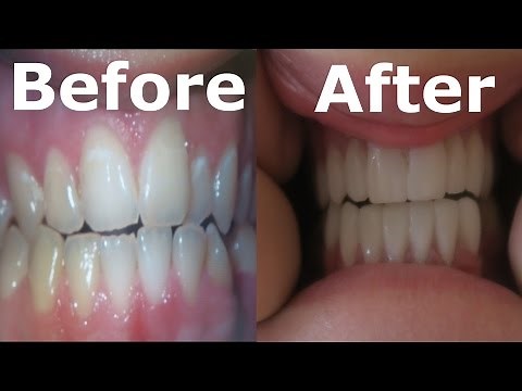 I GOT VENEERS!! | FaZe Rug