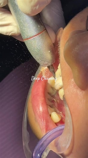 Understanding Deep Cleaning in Dentistry