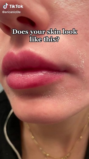 The BEST to heal dry, flaky, sensitized acne-prone skin #acne #acnetreatment #acneskin #acneproneskin #acneskincare #acnetips #skincaretips #acnetips #skincare101 #cicaplastbaumeb5 #cicaplast #barrierrepair #skinbarrier #damagedskinbarrier