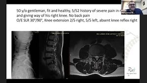 MIS Far Lateral Discectomy
