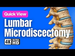 Lumbar Microdiscectomy of the Spine // See How It Works // 3D Animation