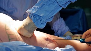 Risks with the Liposuction Procedure