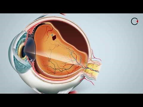 Descolamento - Retina - HOA
