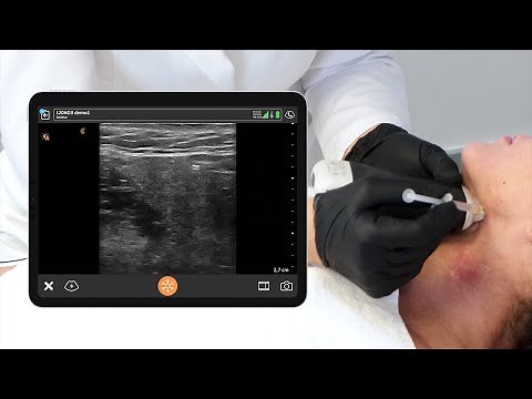 Ultrasound of the Submandibular Gland