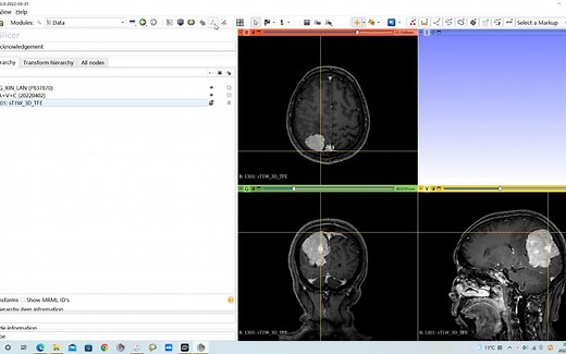 3D-slicer肿瘤自动分割NVIDIA AI-assisted annotation