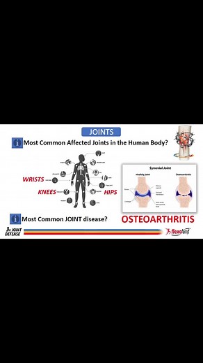 Arthritis: Recognizing Symptoms and Treatment Options